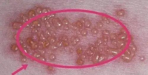 最新疱疹治疗方法揭秘，小巷深处的神秘小店探索